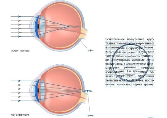 Сферические аберрации глаза