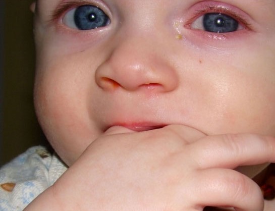 Аденовирусный конъюнктивит у ребенка