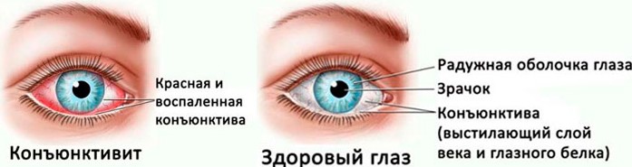 Здоровый глаз и глаз с конъюнктивитом