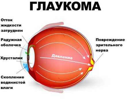 Глаукома причины возникновения болезни