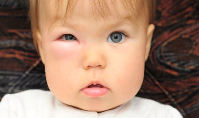 Комар укусил ребенка в глаз