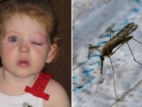 После укуса комара у ребенка опух глаз
