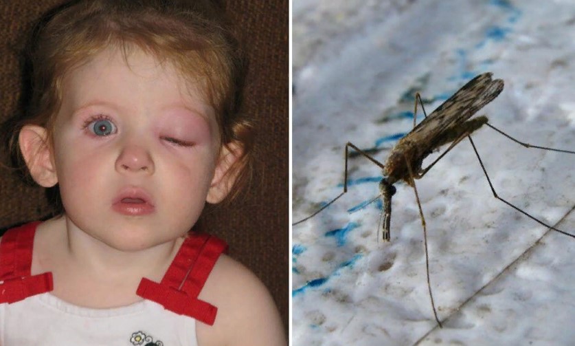 Опух глаз после укуса комара у ребенка
