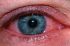 Лечение покраснения глаз в домашних условиях